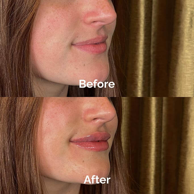 Before and After Results of Treatment at MediZen Institute in Columbus, OH 01