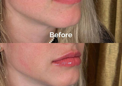 Before and After Results of Treatment at MediZen Institute in Columbus, OH 10