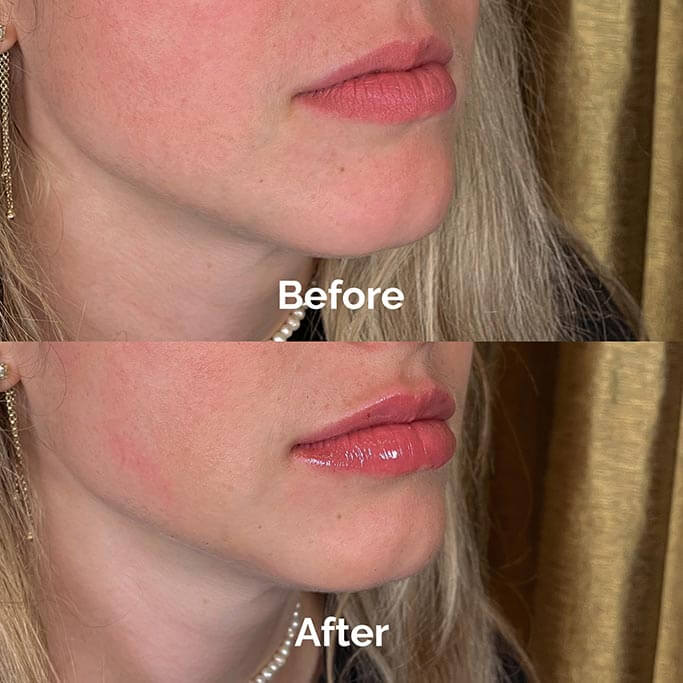Before and After Results of Treatment at MediZen Institute in Columbus, OH 10
