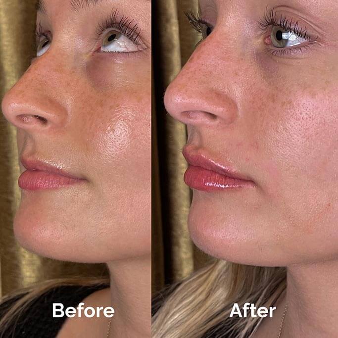 Before and After Results of Treatment at MediZen Institute in Columbus, OH 11