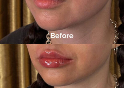 Before and After Results of Treatment at MediZen Institute in Columbus, OH 12