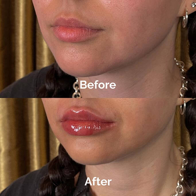 Before and After Results of Treatment at MediZen Institute in Columbus, OH 12