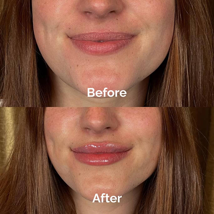 Before and After Results of Treatment at MediZen Institute in Columbus, OH 13