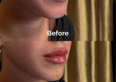 Before and After Results of Treatment at MediZen Institute in Columbus, OH 14