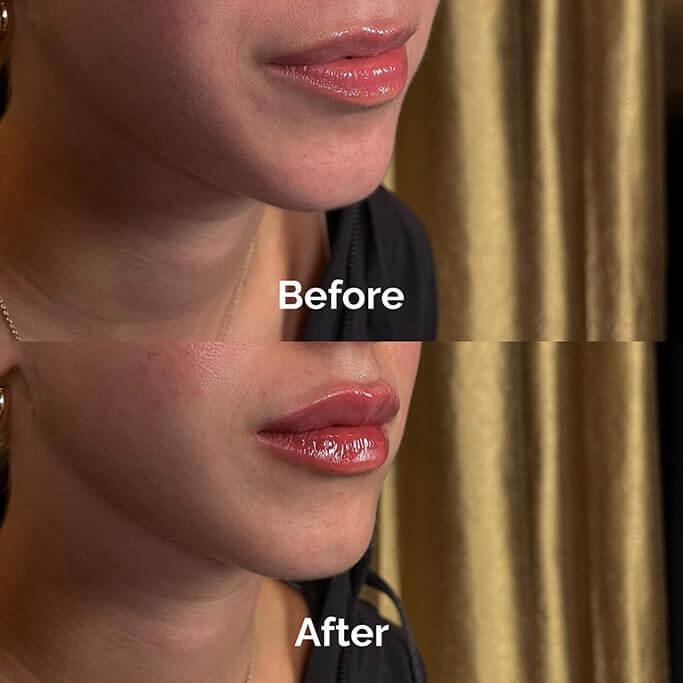 Before and After Results of Treatment at MediZen Institute in Columbus, OH