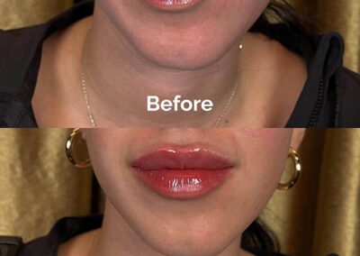 Before and After Results of Treatment at MediZen Institute in Columbus, OH 15