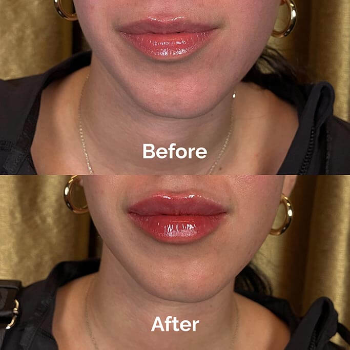 Before and After Results of Treatment at MediZen Institute in Columbus, OH 15