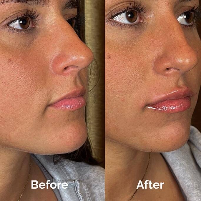 Before and After Results of Treatment at MediZen Institute in Columbus, OH 16