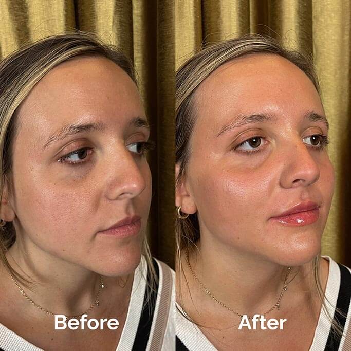 Before and After Results of Treatment at MediZen Institute in Columbus, OH 17