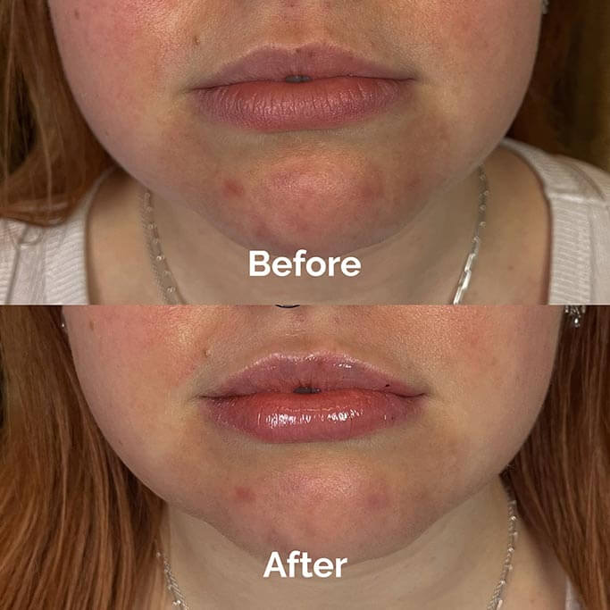 Before and After Results of Treatment at MediZen Institute in Columbus, OH 18