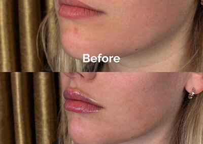 Before and After Results of Treatment at MediZen Institute in Columbus, OH 19