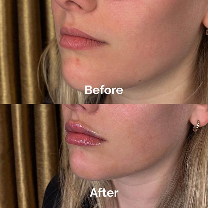 Before and After Results of Treatment at MediZen Institute in Columbus, OH 19