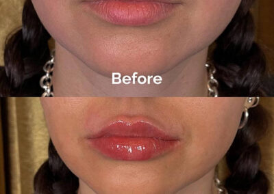 Before and After Results of Treatment at MediZen Institute in Columbus, OH 02