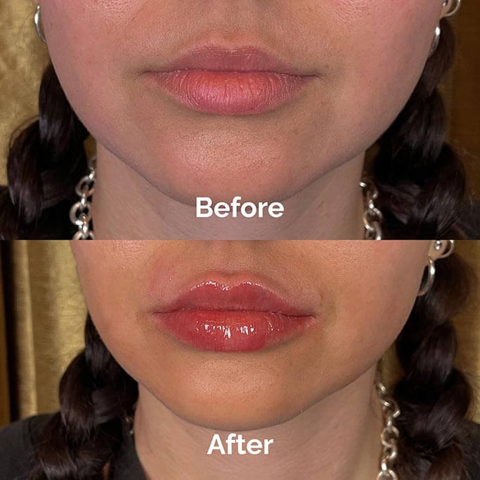Before and After Results of Treatment at MediZen Institute in Columbus, OH 02