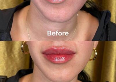 Before and After Results of Treatment at MediZen Institute in Columbus, OH 20