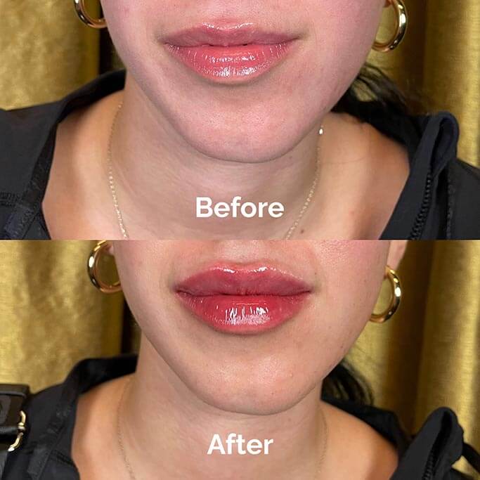 Before and After Results of Treatment at MediZen Institute in Columbus, OH 20