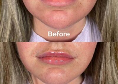 Before and After Results of Treatment at MediZen Institute in Columbus, OH 21