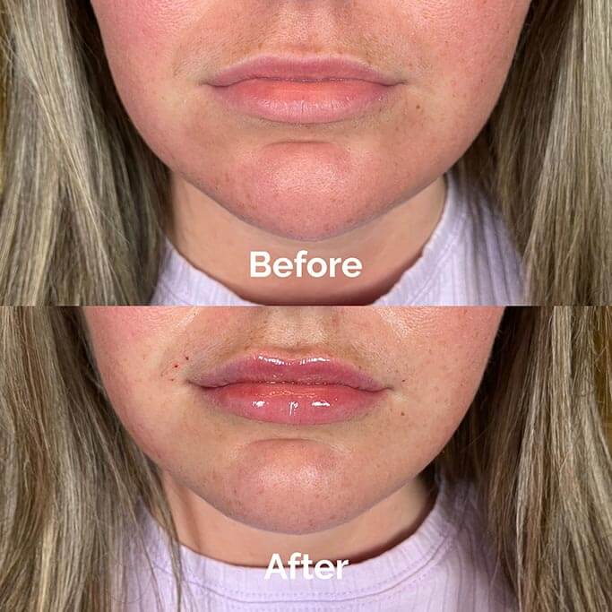 Before and After Results of Treatment at MediZen Institute in Columbus, OH 21