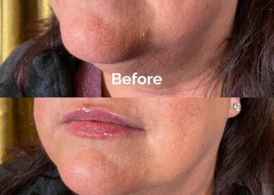 Before and After Results of Treatment at MediZen Institute in Columbus, OH 22