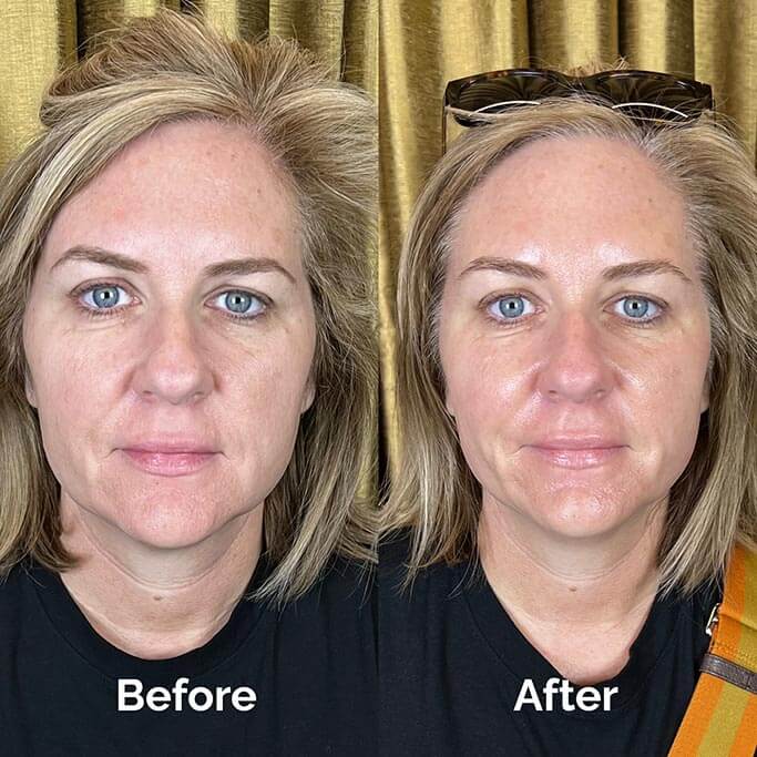Before and After Results of Treatment at MediZen Institute in Columbus, OH 23
