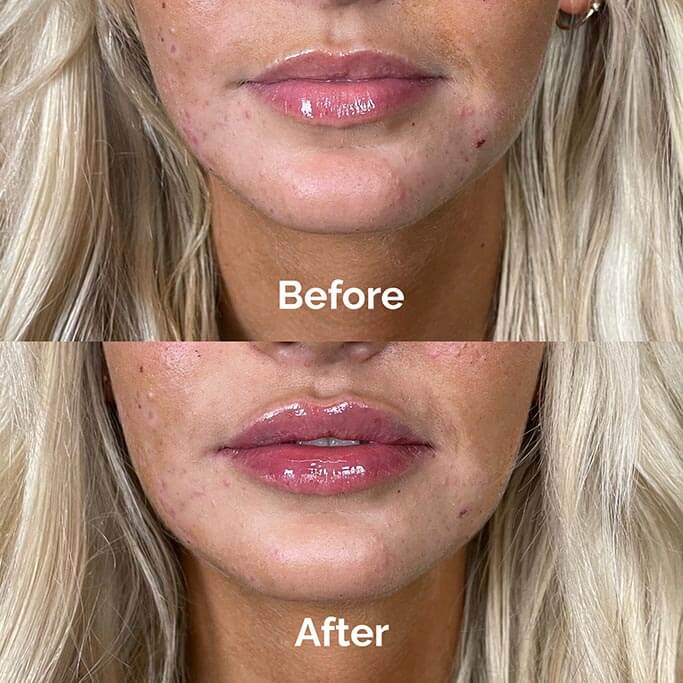 Before and After Results of Treatment at MediZen Institute in Columbus, OH 24