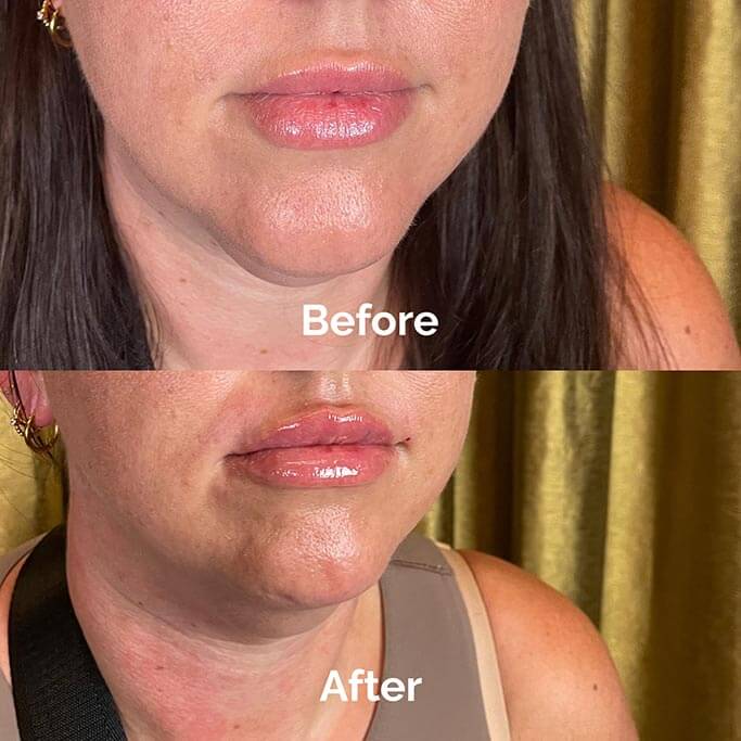 Before and After Results of Treatment at MediZen Institute in Columbus, OH 25