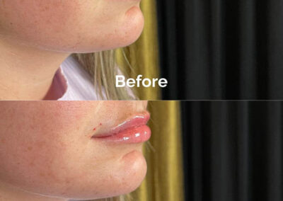 Before and After Results of Treatment at MediZen Institute in Columbus, OH 26