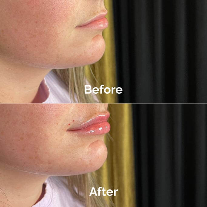 Before and After Results of Treatment at MediZen Institute in Columbus, OH 26