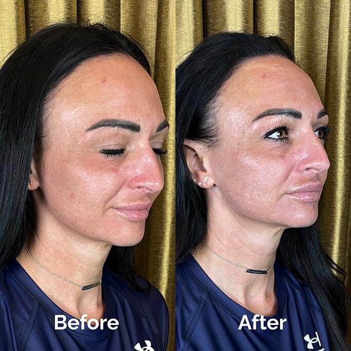Before and After Results of Treatment at MediZen Institute in Columbus, OH 27