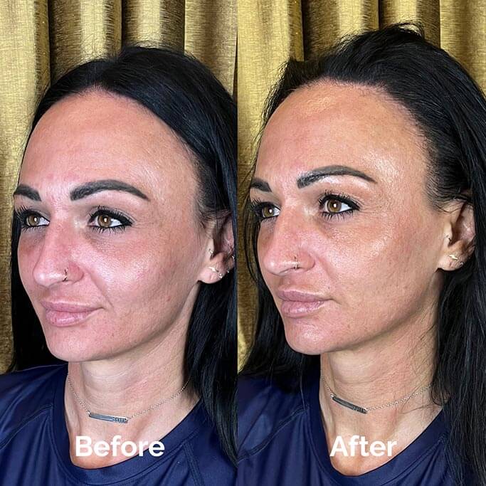 Before and After Results of Treatment at MediZen Institute in Columbus, OH 30