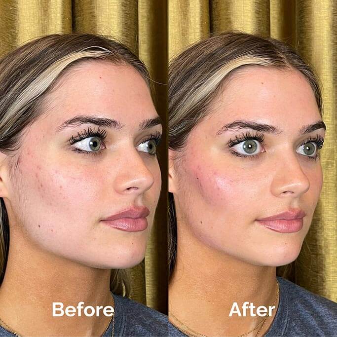 Before and After Results of Treatment at MediZen Institute in Columbus, OH 31