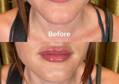 Before and After Results of Treatment at MediZen Institute in Columbus, OH 32