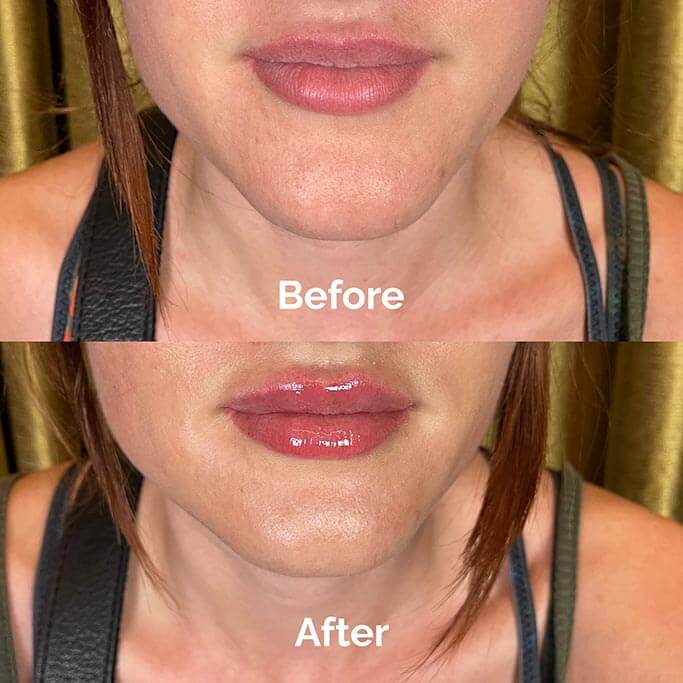 Before and After Results of Treatment at MediZen Institute in Columbus, OH 32