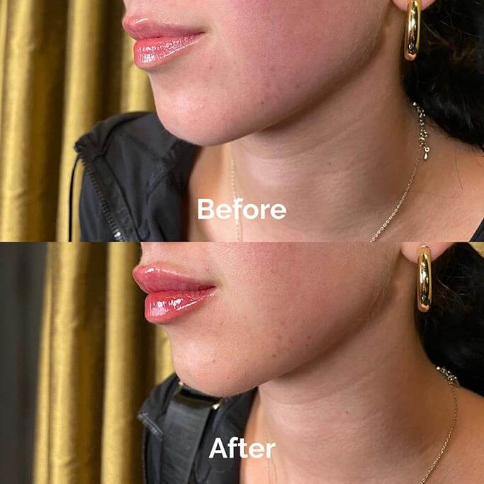 Before and After Results of Treatment at MediZen Institute in Columbus, OH 34
