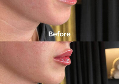 Before and After Results of Treatment at MediZen Institute in Columbus, OH 35
