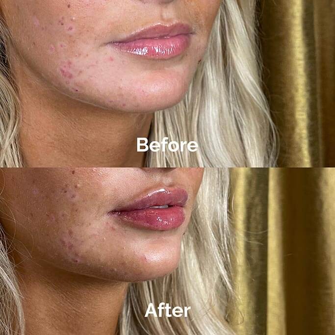 Before and After Results of Treatment at MediZen Institute in Columbus, OH 36