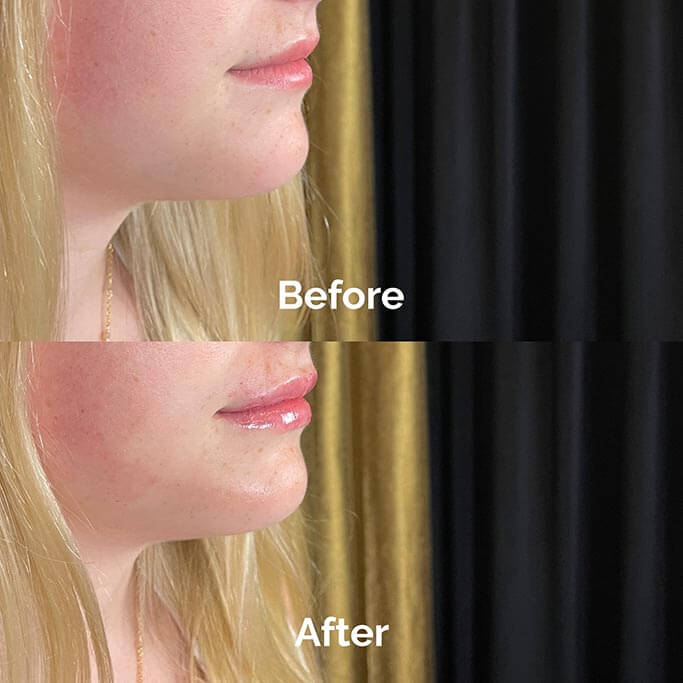 Before and After Results of Treatment at MediZen Institute in Columbus, OH 37