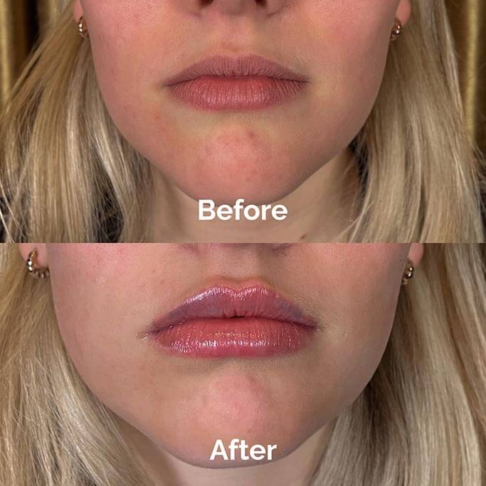 Before and After Results of Treatment at MediZen Institute in Columbus, OH 04