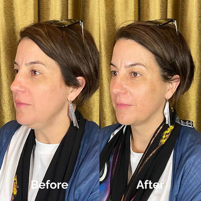 Before and After Results of Treatment at MediZen Institute in Columbus, OH 42