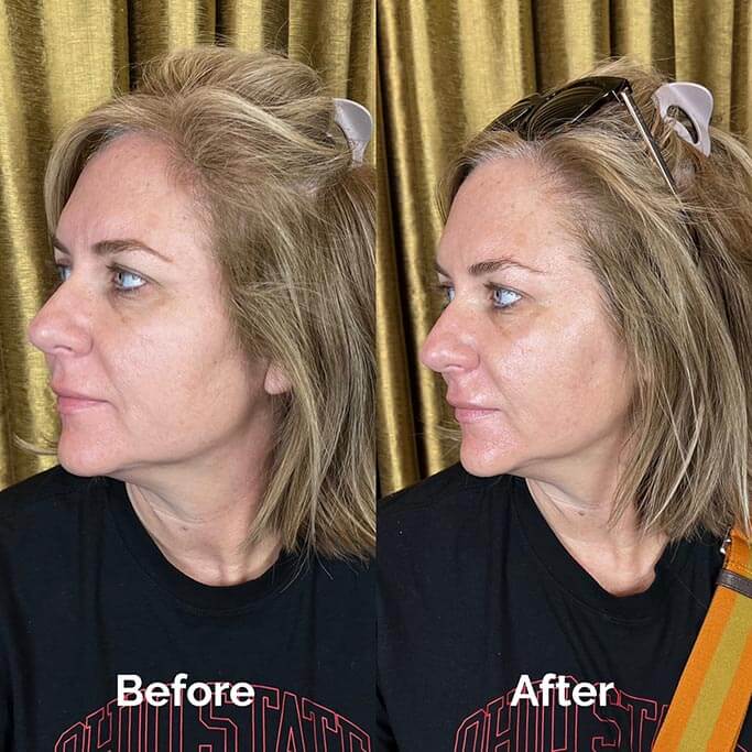 Before and After Results of Treatment at MediZen Institute in Columbus, OH 43