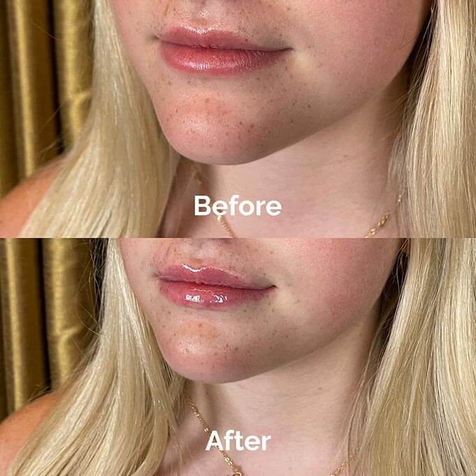 Before and After Results of Treatment at MediZen Institute in Columbus, OH 44