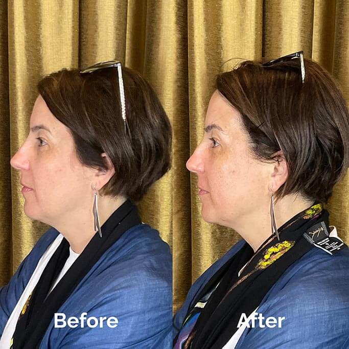 Before and After Results of Treatment at MediZen Institute in Columbus, OH 45
