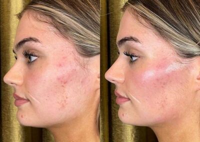 Before and After Results of Treatment at MediZen Institute in Columbus, OH 47