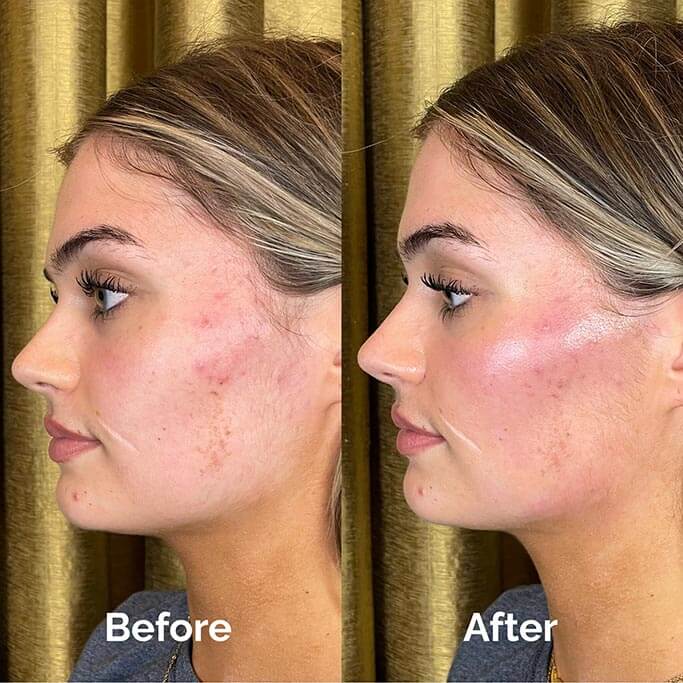 Before and After Results of Treatment at MediZen Institute in Columbus, OH 47