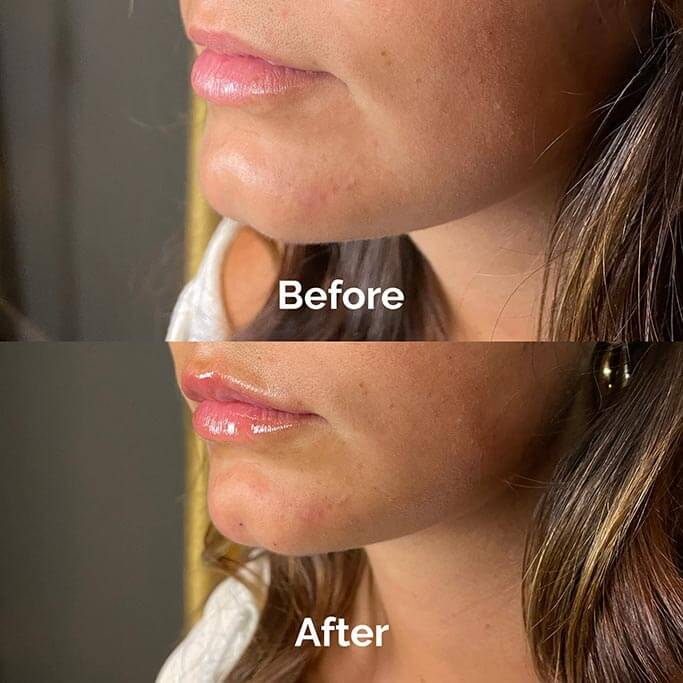 Before and After Results of Treatment at MediZen Institute in Columbus, OH 48