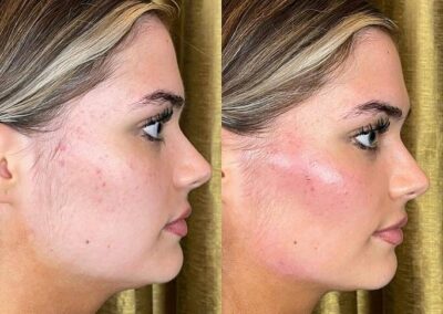 Before and After Results of Treatment at MediZen Institute in Columbus, OH 49
