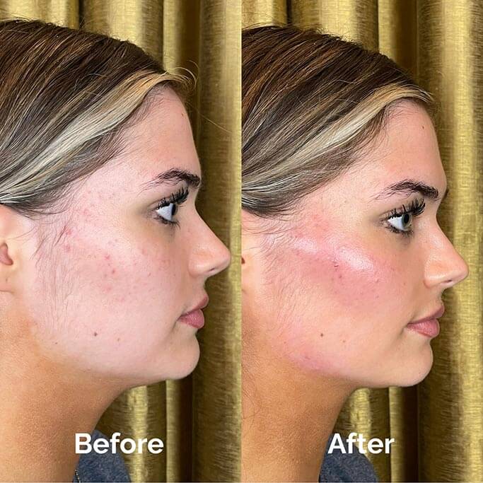 Before and After Results of Treatment at MediZen Institute in Columbus, OH 49