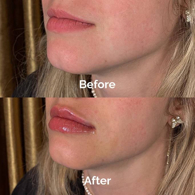Before and After Results of Treatment at MediZen Institute in Columbus, OH 05