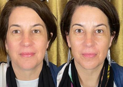 Before and After Results of Treatment at MediZen Institute in Columbus, OH 50