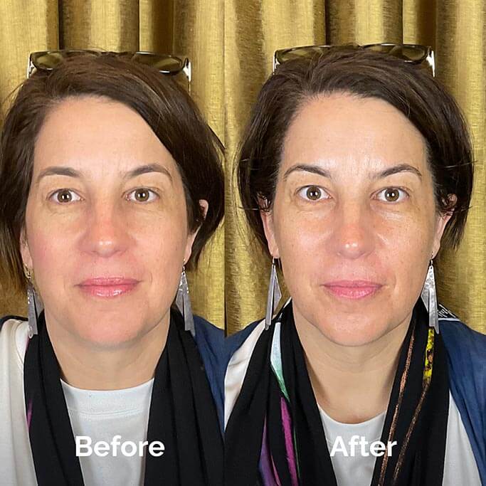 Before and After Results of Treatment at MediZen Institute in Columbus, OH 50